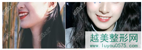 北京中诺口腔隐形托槽矫牙齿正案例