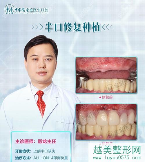 广州牙齿种植医生殷龙半口种植案例