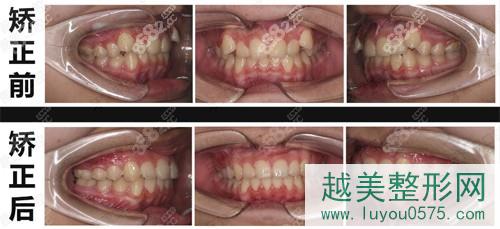 北京牙管家口腔牙齿矫正案例