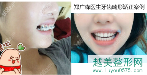 广州中大光华口腔郑广森医生牙齿正畸案例前后对比