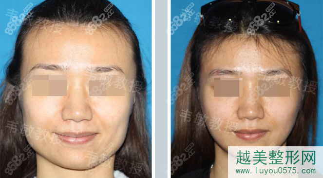 上海韦敏下颌角手术案例
