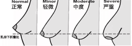 乳房下垂分级示意图
