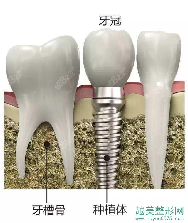 上海鼎植口腔种植牙步骤过程图解