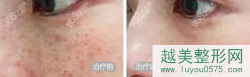 北京美莱超激光美肤祛斑真人案例对比图