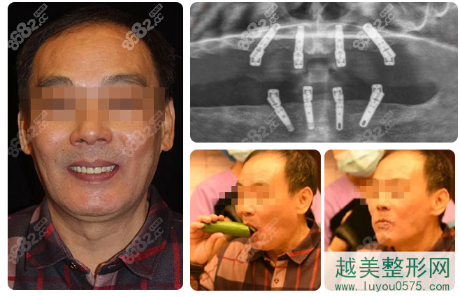 北京劲松口腔全口种植牙案例