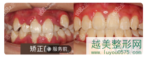 北京劲松口腔医院隐形牙齿正畸案例