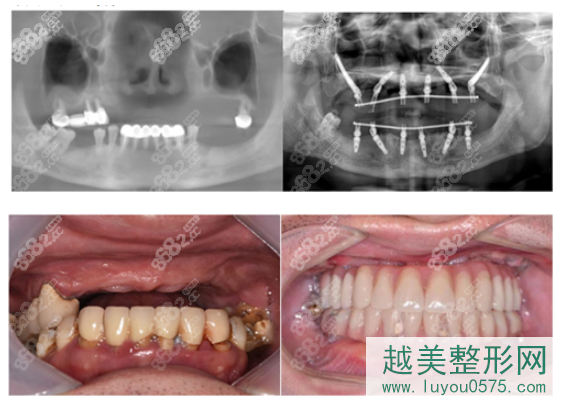 上海鼎植口腔全口种植牙案例