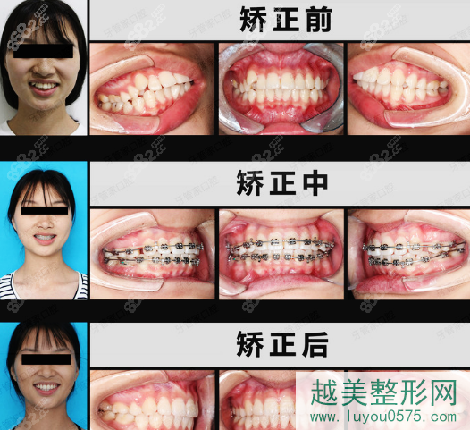 北京牙管家口腔医院牙齿矫正案例
