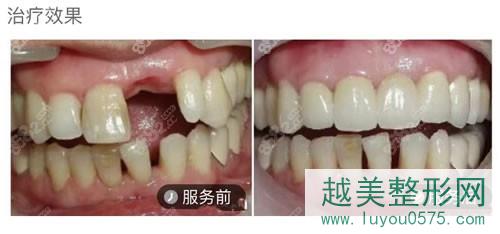 北京钛植口腔门诊种植牙案例