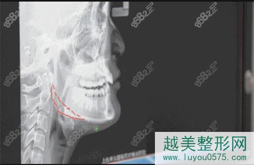 上海首尔丽格下颌角手术设计