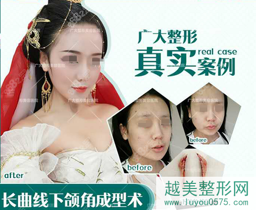 广州广大整形美容医院下颌角手术案例