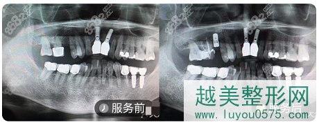 北京佳美口腔种植牙案例