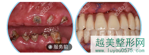 上海鼎植口腔高振华医生全口种植牙案例