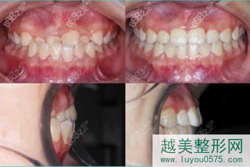 广州美莱口腔医院牙齿矫正案例