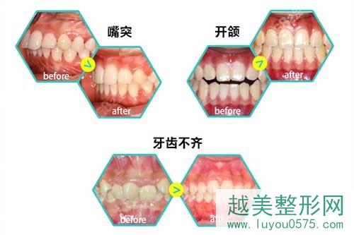 广州瑞德口腔医院牙齿矫正案例