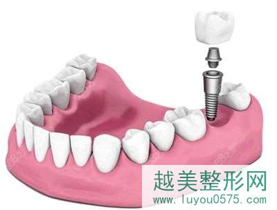 北京雅医家口腔医院种植牙好吗