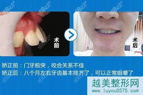 广州穗华口腔医院牙齿矫正案例