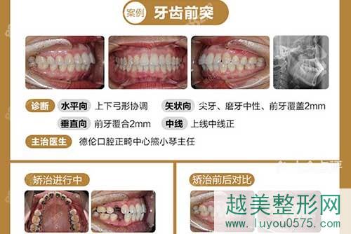 广州德伦口腔医院牙齿矫正案例