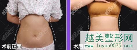 北京美莱吸脂瘦腰腹部真人前后对比照