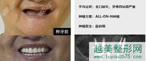 广州柏德口腔医院种植牙案例