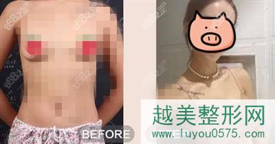北京美莱医疗美容隆胸案例