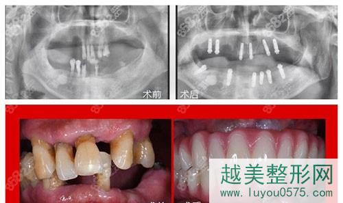 广州广大口腔医院种植牙案例