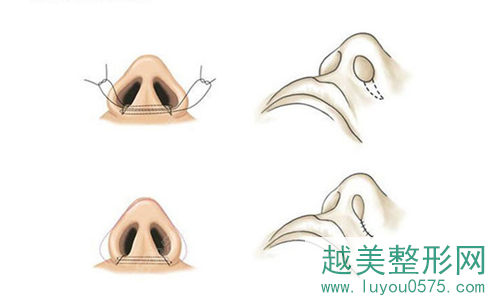 上海第九人民医院鼻翼缩小方法