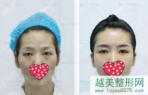 北京东方和谐冯斌全脸脂肪填充术前术后对比照