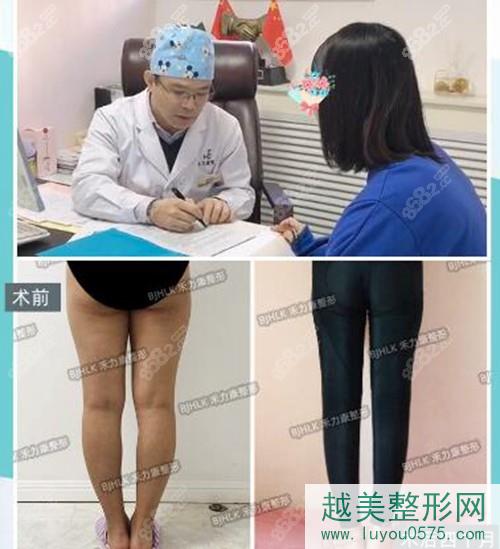 北京禾力康整形金尚训腿型矫正案例