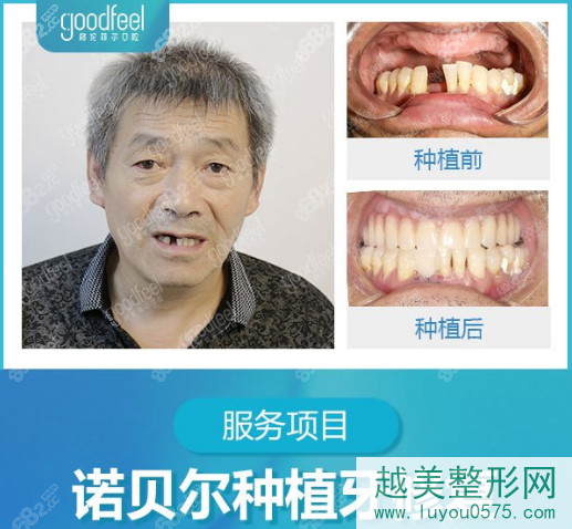 深圳格伦菲尔口腔种植牙案例