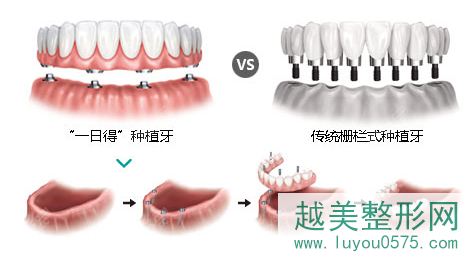 北京维尔口腔种植牙技术优势
