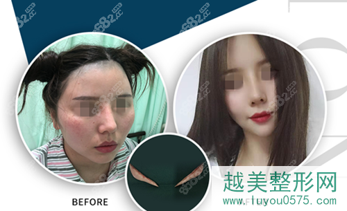 上海仁爱医院下颌角手术案例