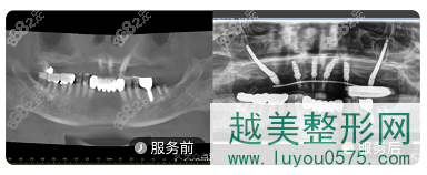 北京中科领军口腔医院穿颧种植牙案例