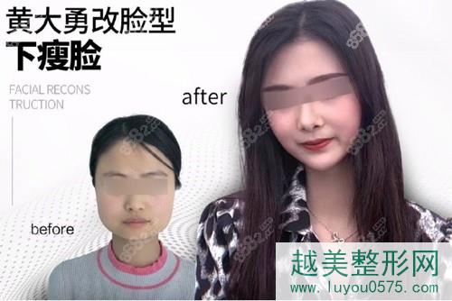 北京圣嘉荣黄大勇下颌角手术术前术后对比