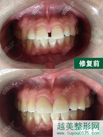 武汉大众口腔牙齿修复案例