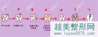 牙齿龋齿过程