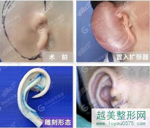 耳再造全包法手术过程