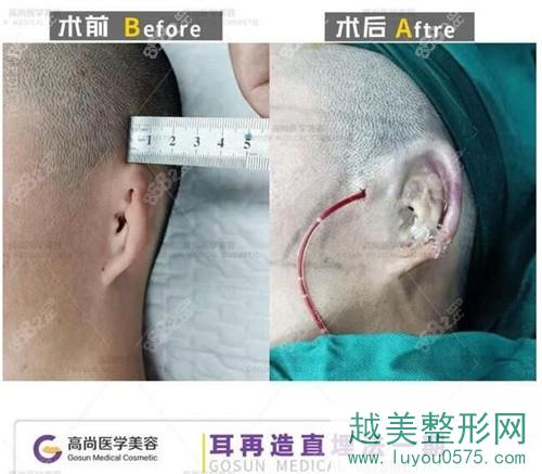 耳再造直埋法手术过程
