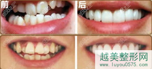 上海圣贝口腔牙齿矫正案例