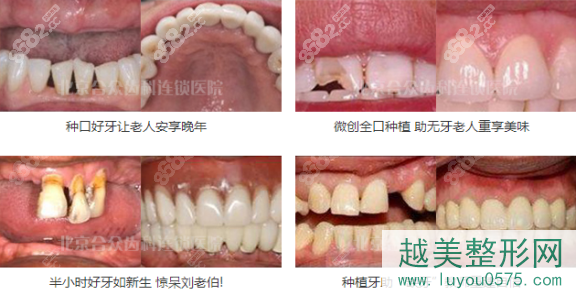 北京合众齿科种植案例