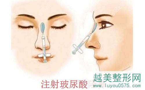 玻尿酸隆鼻手术动漫图