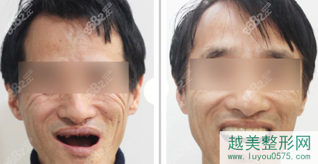 上海薇琳口腔科种植牙齿的案例