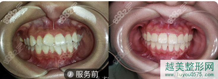 宁波牙博士口腔医院自锁托槽牙齿矫正案例