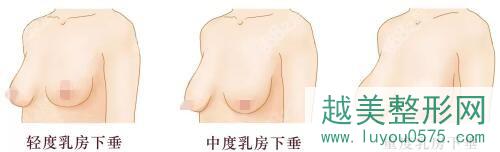胸部下垂松弛的三种不同程度
