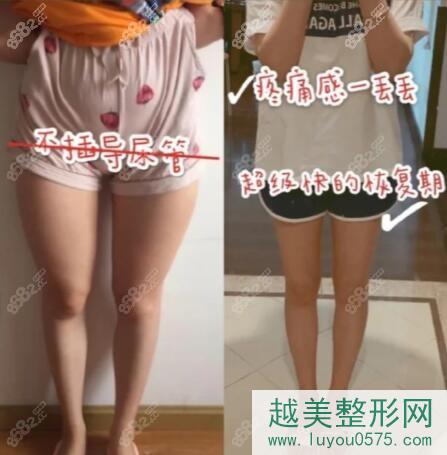 天津市医院整形科宋宝骥医生大腿环吸案例