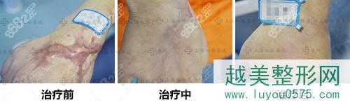 上海虹桥疤痕医院祛疤前后对比