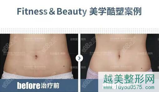 北京联合丽格酷塑冷冻减脂瘦腰腹对比案例图