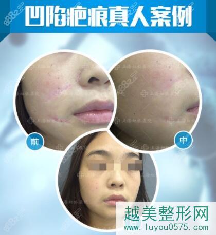 上海虹桥医院治疗凹陷疤痕对比案例照