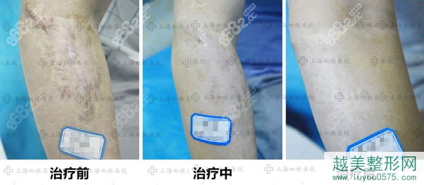 上海虹桥医院疤痕科治疗烧伤疤痕怎么样