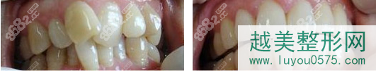 银川矫牙专业的艾齿口腔牙齿矫正案例